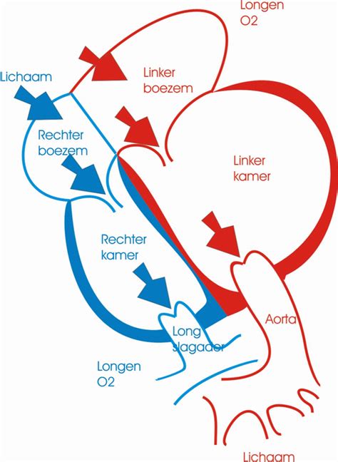 Idiopathische gedilateerde cardiomyopathie (DCM) .